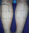 Comparison among Intense Pulsed Light, Alexandrite, and Long-Pulsed Neodymium-Doped Yttrium Aluminum Garnet 1064 Nm Lasers for Lower Leg Hair Removal: Case Series.