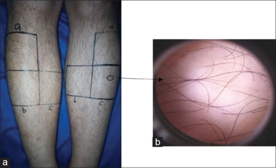Comparison among Intense Pulsed Light, Alexandrite, and Long-Pulsed Neodymium-Doped Yttrium Aluminum Garnet 1064 Nm Lasers for Lower Leg Hair Removal: Case Series.
