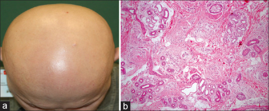 The Association between Number of Follicular Stelae and Severity and Treatment Response of Alopecia Areata Cases: A Retrospective Study.