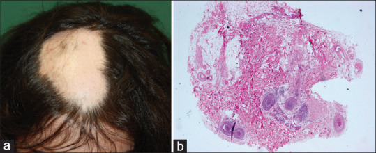 The Association between Number of Follicular Stelae and Severity and Treatment Response of Alopecia Areata Cases: A Retrospective Study.