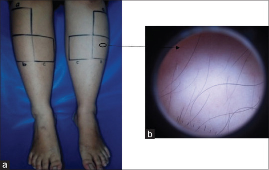 Comparison among Intense Pulsed Light, Alexandrite, and Long-Pulsed Neodymium-Doped Yttrium Aluminum Garnet 1064 Nm Lasers for Lower Leg Hair Removal: Case Series.