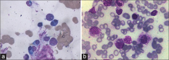 Morphological Spectrum of Bone Marrow Aspirates in Infections: A Clinico-Hematological Analysis.