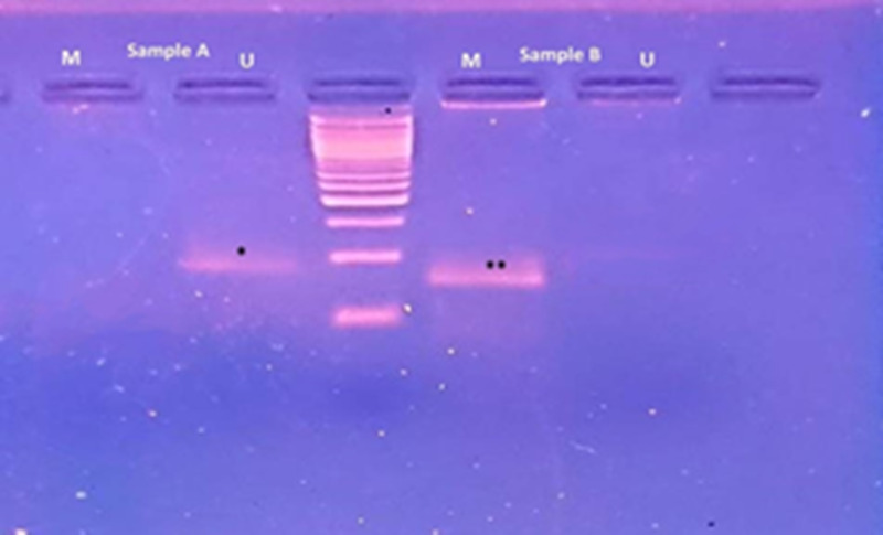 Prognostic Significance and Clinicopathological Correlations of Epigenetic MGMT Gene Silencing in High Grade Diffuse Gliomas.