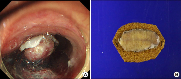 Primary Esophageal Mucosa-associated Lymphoid Tissue Lymphoma: A Rare Case Report and Review of Other Published Data.