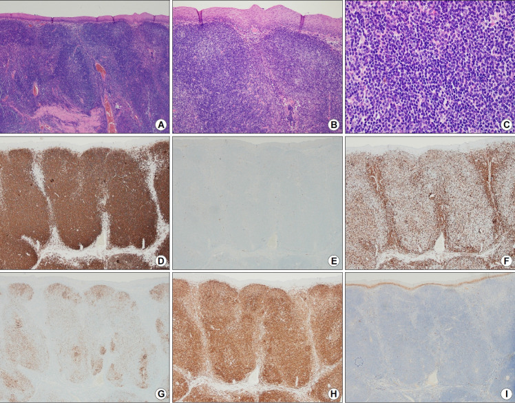 Primary Esophageal Mucosa-associated Lymphoid Tissue Lymphoma: A Rare Case Report and Review of Other Published Data.
