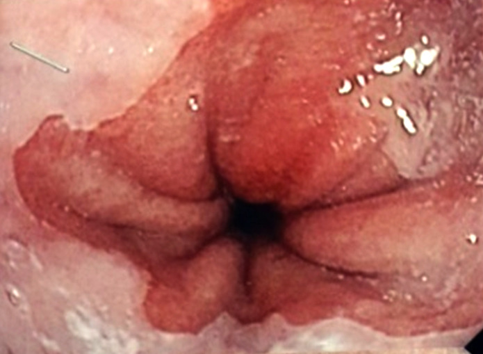 [A rare association of Takayasu's disease and inflammatory bowel disease in Gabon].