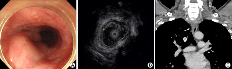 Primary Esophageal Mucosa-associated Lymphoid Tissue Lymphoma: A Rare Case Report and Review of Other Published Data.