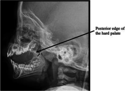 Clinical presentation, radiographic findings, and treatment outcomes in children with adenoid hypertrophy in a paediatric outpatient clinic in Enugu, Nigeria.