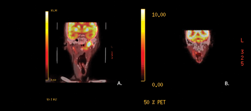 Nasopharyngeal Carcinoma: Case Presentation and Literature Review of Treatment Innovation with Immunotherapy.