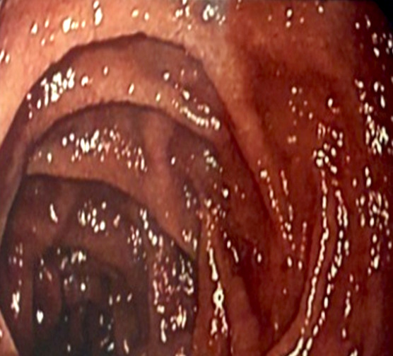 [A rare association of Takayasu's disease and inflammatory bowel disease in Gabon].