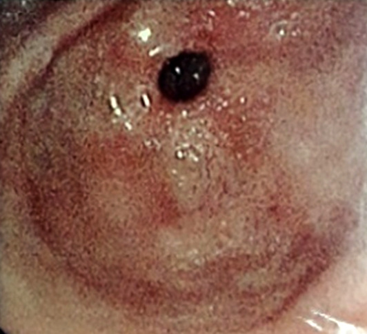 [A rare association of Takayasu's disease and inflammatory bowel disease in Gabon].