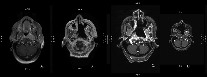 Nasopharyngeal Carcinoma: Case Presentation and Literature Review of Treatment Innovation with Immunotherapy.