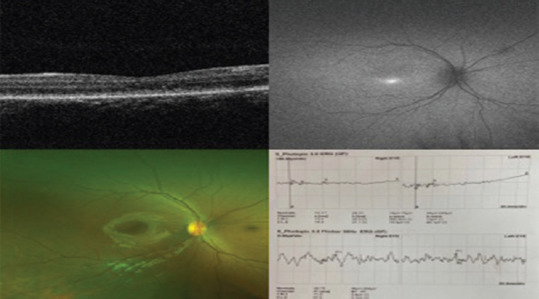 Phenotype and genotype of 15 Saudi patients with achromatopsia: A case series.