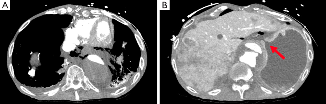 A rare case of combined black esophagus and stomach: a case report.