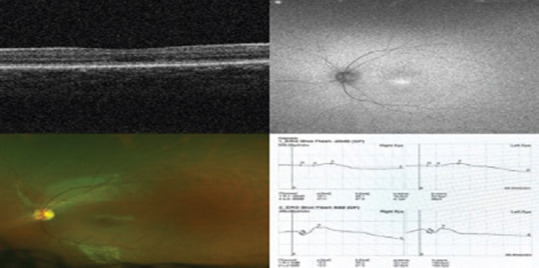 Phenotype and genotype of 15 Saudi patients with achromatopsia: A case series.