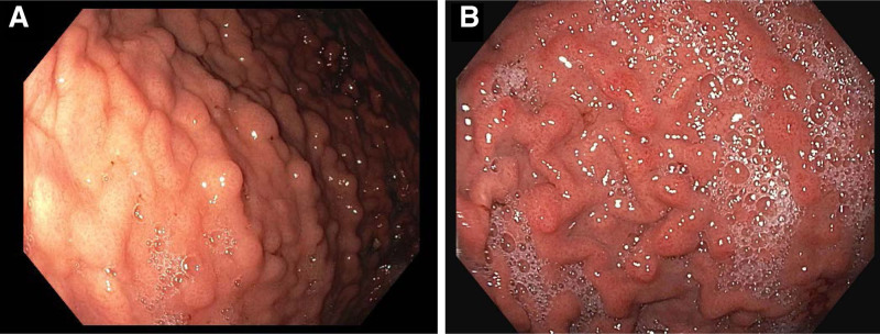 Literature Review and a Relevant Case of Pediatric Collagenous Gastritis: A Rare but Important Etiology of Iron-Deficiency Anemia.