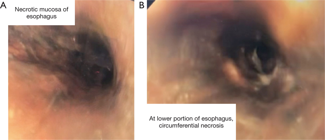 A rare case of combined black esophagus and stomach: a case report.