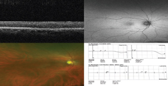 Phenotype and genotype of 15 Saudi patients with achromatopsia: A case series.