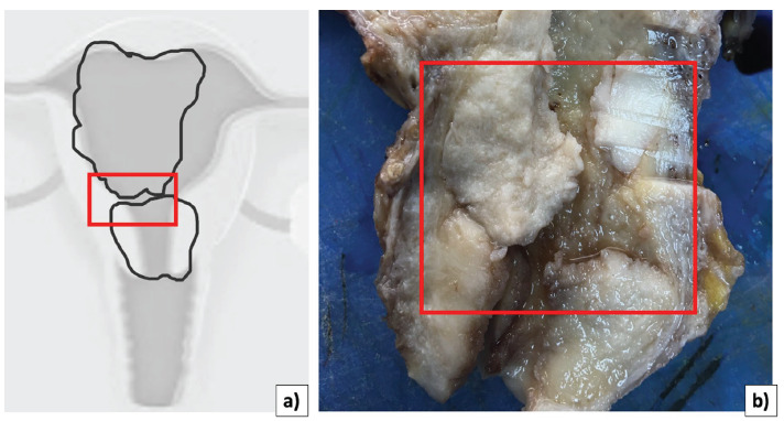 Uterine collision tumor. Case report and review of the literature