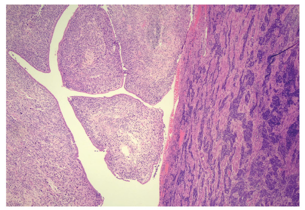 Uterine collision tumor. Case report and review of the literature