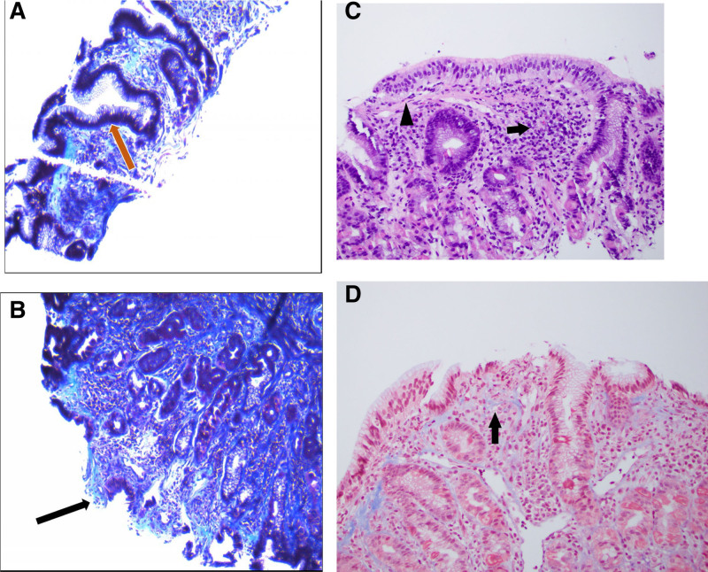 Literature Review and a Relevant Case of Pediatric Collagenous Gastritis: A Rare but Important Etiology of Iron-Deficiency Anemia.