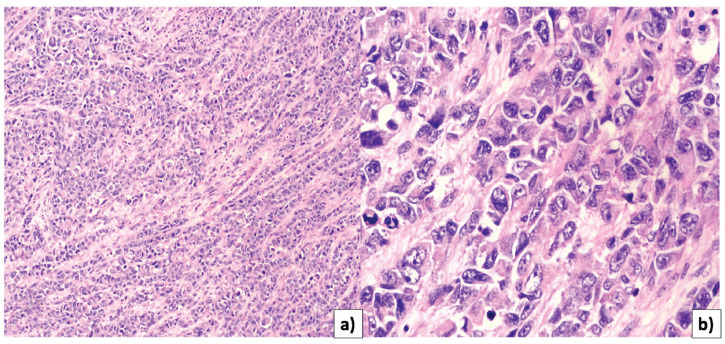 Uterine collision tumor. Case report and review of the literature
