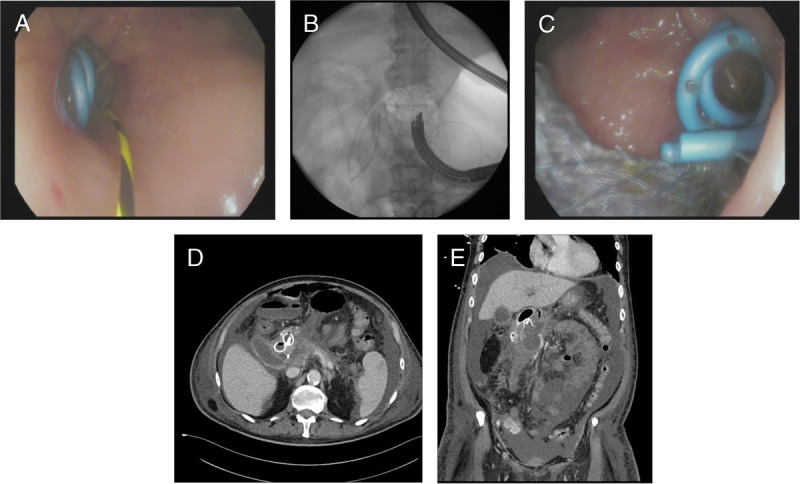 Mishaps with EUS-guided lumen-apposing metal stents in therapeutic pancreatic EUS: Management and prevention.