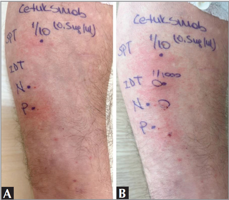 Delayed anaphylaxis due to Alpha-gal allergy: A modified desensitization protocol with red meat in an adult patient.