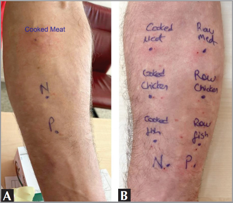 Delayed anaphylaxis due to Alpha-gal allergy: A modified desensitization protocol with red meat in an adult patient.