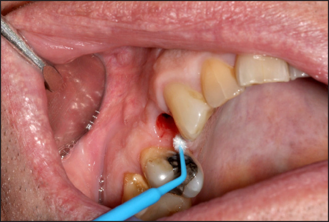 Inflammatory Gene Profile and Particle Presence in Peri-Implant Mucosa: a Pilot Study on 9 Patients.