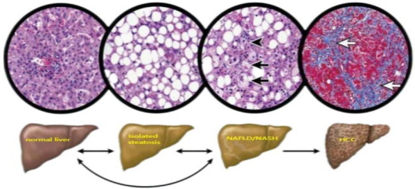 Exercise-mediated macrophage polarization modulates the targeted therapeutic effect of NAFLD: a review.