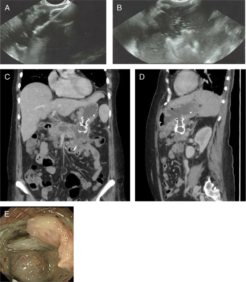 Mishaps with EUS-guided lumen-apposing metal stents in therapeutic pancreatic EUS: Management and prevention.