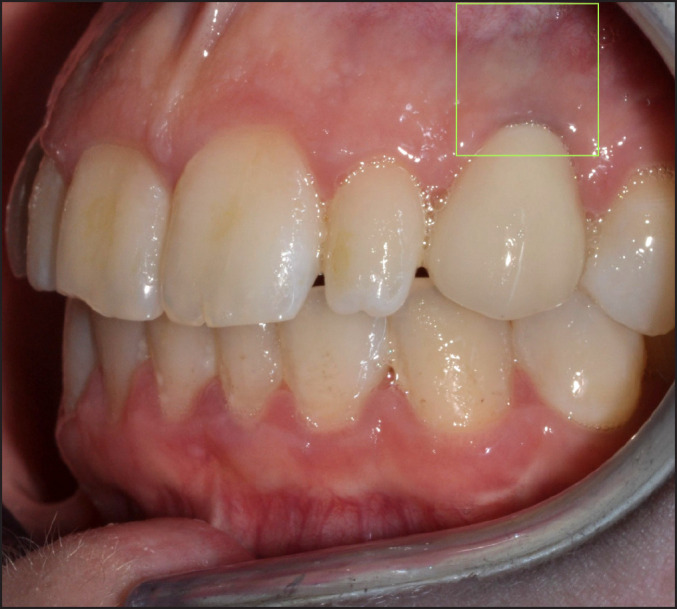 Inflammatory Gene Profile and Particle Presence in Peri-Implant Mucosa: a Pilot Study on 9 Patients.