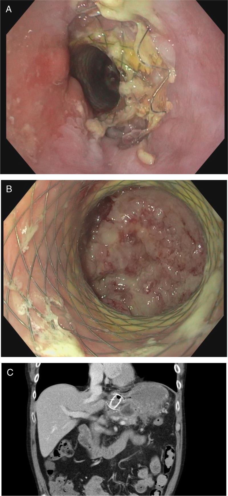 Mishaps with EUS-guided lumen-apposing metal stents in therapeutic pancreatic EUS: Management and prevention.