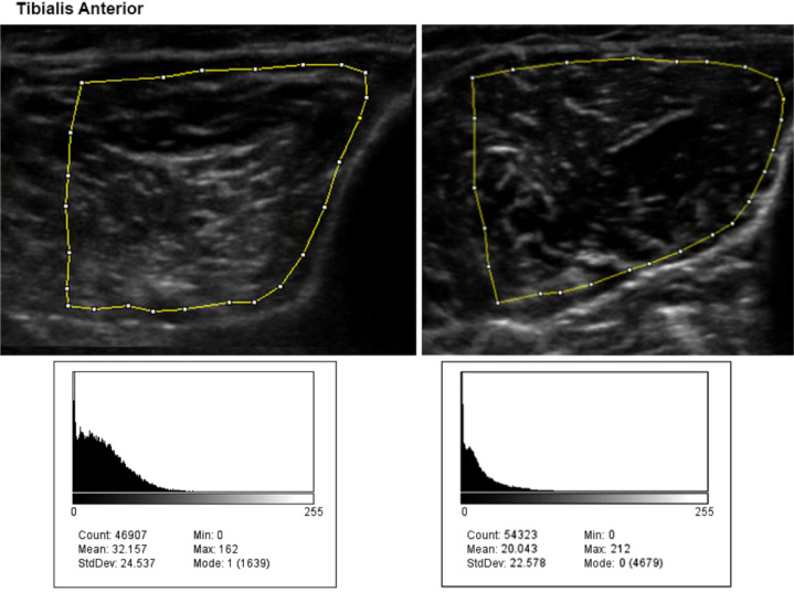 Investigating the Association Between Muscular Ultrasonographic Alterations and Clinical Symptoms in Patients With Inflammatory Myopathy.
