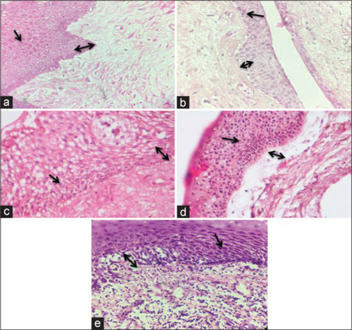 A Light and Ultrastructural Analysis in Odontogenic Cysts and Oral Squamous Cell Carcinoma.