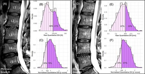 Development of normalized quantitative measures of lumbar disc degeneration