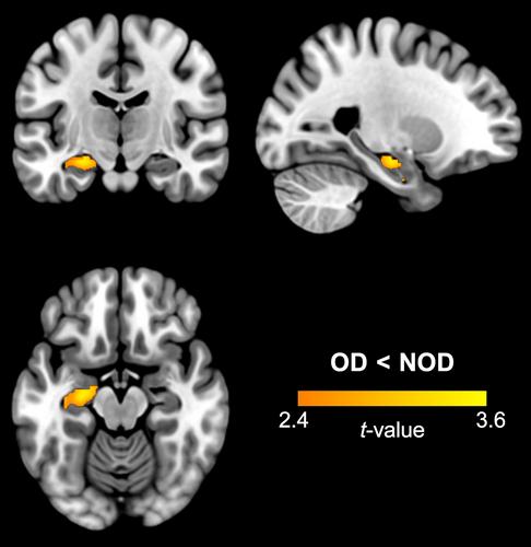 Hippocampal volume loss in individuals with a history of non-fatal opioid overdose