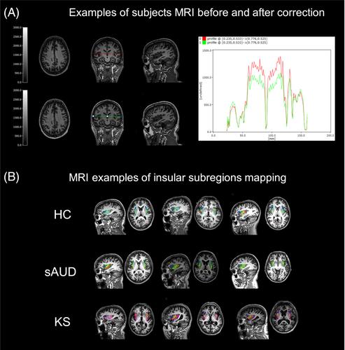 Insular volumetry in severe alcohol use disorder and Korsakoff's syndrome through an anatomical parcellation: Let us go back to basics