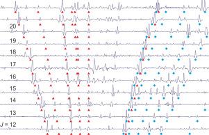 H2O-HF dimer rotational spectra: New measurements and re-analysis