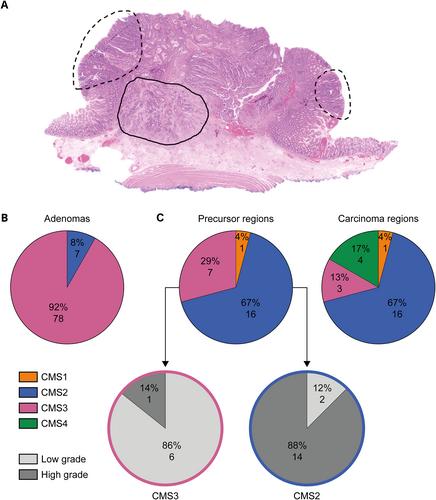 Consensus molecular subtype transition during progression of colorectal cancer