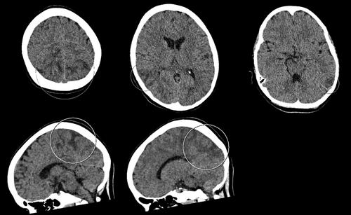 Posterior reversible encephalopathy syndrome in a child, following splenectomy under combined general and spinal anaesthesia