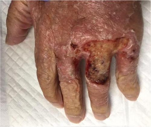 Disseminated cryptococcosis in a geriatric man following high-dose systemic steroid therapy for severe COVID-19 pneumonia