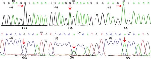 Correlation analysis of IL-37 gene polymorphisms and susceptibility to chronic HBV infection among Han people in Central China