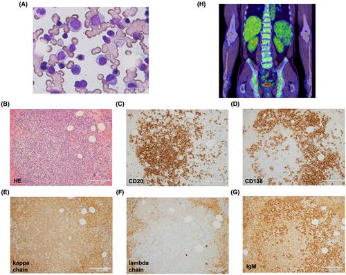 Lymphoplasmacytic lymphoma presenting cold agglutinin syndrome: Clonal expansion of KMT2D and IGHV4-34 mutations after COVID-19