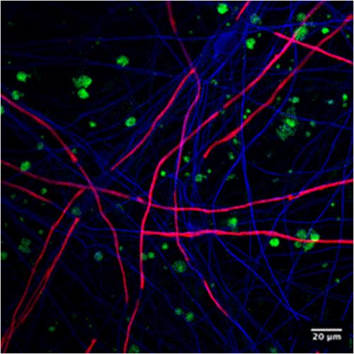 Nodal–paranodal antibodies in HIV-immune mediated radiculo-neuropathies: Clinical phenotypes and relevance