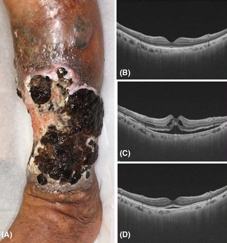 Two cases of acute-onset cystoid macular edema and serous retinal detachment associated with combined use of encorafenib and binimetinib for advanced melanoma: A possible confounding risk for drug intolerance