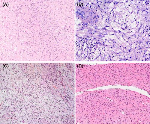 Novel NCOA2/3-rearranged low-grade fibroblastic spindle cell tumors: A report of five cases