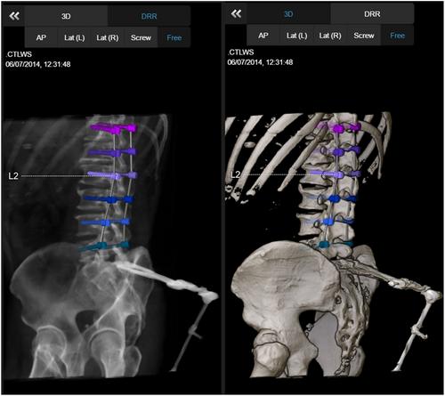 Man versus machine: Automatic pedicle screw planning using registration-based techniques compared with manual screw planning for thoracolumbar fusion surgeries