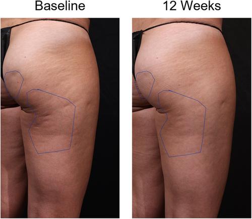 Comparing safety and efficacy of acoustic subcision at two different rapid acoustic pulse rates to improve the appearance of cellulite